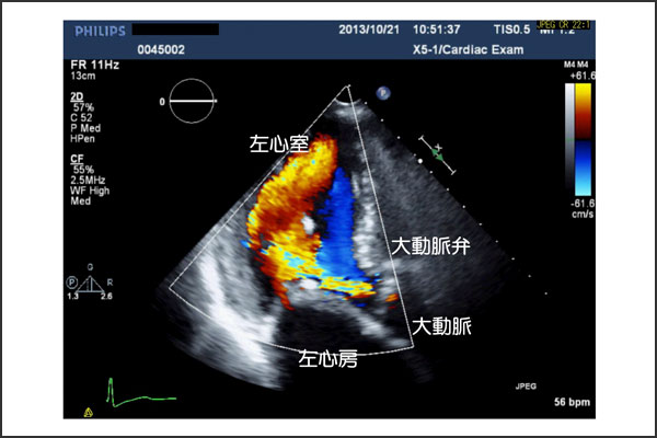 三尖弁閉鎖不全症 逆流 心臓弁膜症 手術 みどり病院 神戸市西区
