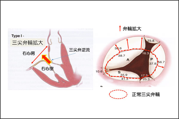 三尖弁閉鎖不全症 逆流 心臓弁膜症 手術 みどり病院 神戸市西区