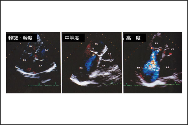 三尖弁閉鎖不全症 逆流 心臓弁膜症 手術 みどり病院 神戸市西区