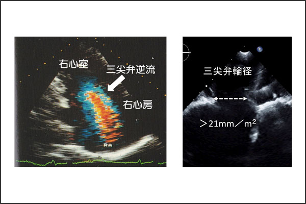 三尖弁閉鎖不全症 逆流 心臓弁膜症 手術 みどり病院 神戸市西区