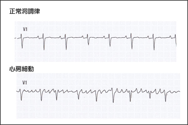 三尖弁閉鎖不全症 逆流 心臓弁膜症 手術 みどり病院 神戸市西区