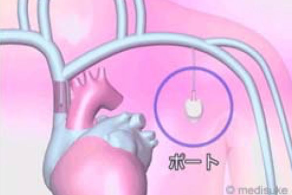 最近増えている手術依頼 ｃｖポート 心臓弁膜症 手術 みどり病院 神戸市西区