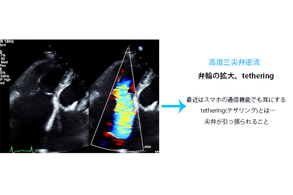 三尖弁逆流と右心機能 心臓弁膜症 手術 みどり病院 神戸市西区