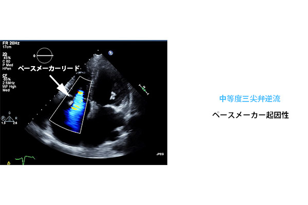 三尖弁逆流と右心機能 心臓弁膜症 手術 みどり病院 神戸市西区