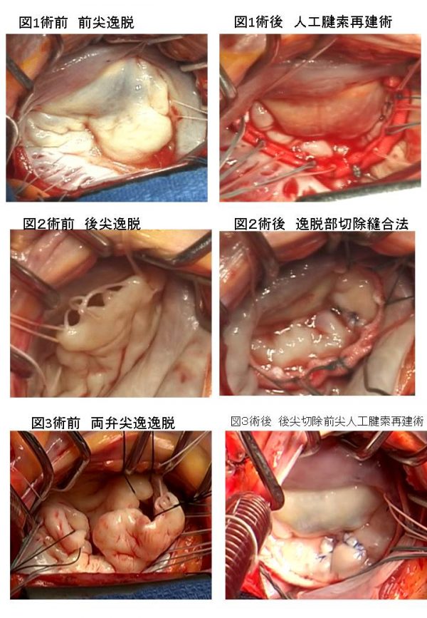 みどり病院での僧帽弁逆流に対する、僧帽弁形成術 ～みどり病院の経験