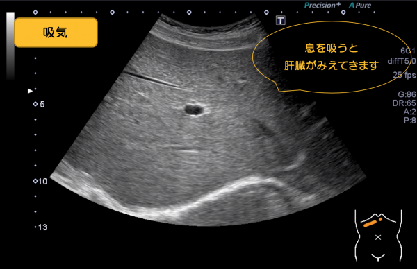 腹部超音波検査 Vol 1 みえやすくする工夫 食事 呼吸 体位変換 圧迫 心臓弁膜症 手術 みどり病院 神戸市西区
