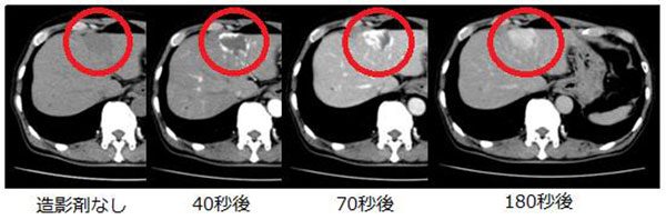 肝臓がんを見極めろ 造影ctでわかる肝血管腫と肝細胞がんの違い 心臓弁膜症 手術 みどり病院 神戸市西区