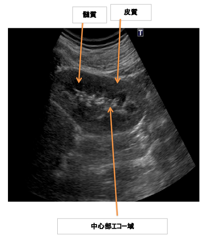 腎臓疾患の超音波像あれこれ 腹部超音波検査Vol.8~腎臓編パート2 
