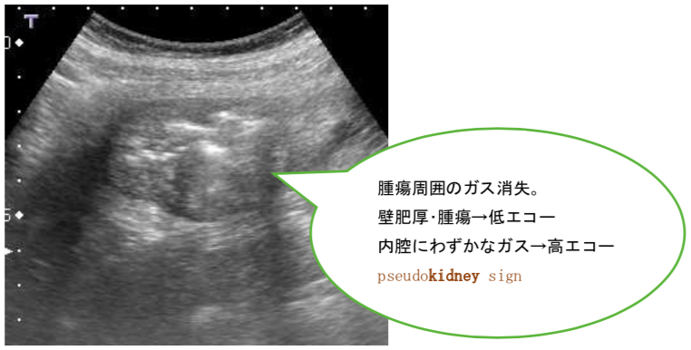 超音波でみる病気の腸 小腸 大腸 腹部超音波検査vol 9 2 心臓弁膜症 手術 みどり病院 神戸市西区
