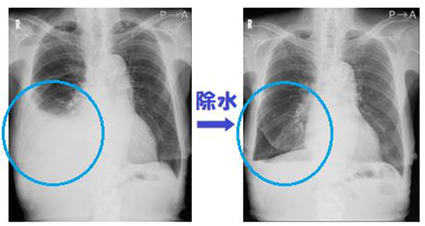 その息切れ本当に大丈夫 肺の病気vol 3 Ct画像で見る 無気肺 心臓弁膜症 手術 みどり病院 神戸市西区